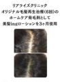 クリニックオリジナル治療＆美髪ingローションをホームケアで使用し発毛した例